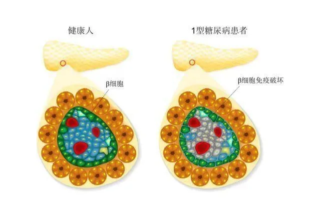 日本研究显示糖尿病患者中暑风险更高