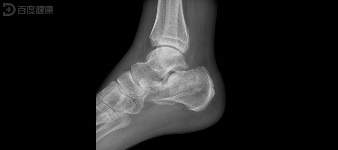 威高骨科获得发明专利授权：“一种用于跟骨置换的定制跟骨假体及制造方法”