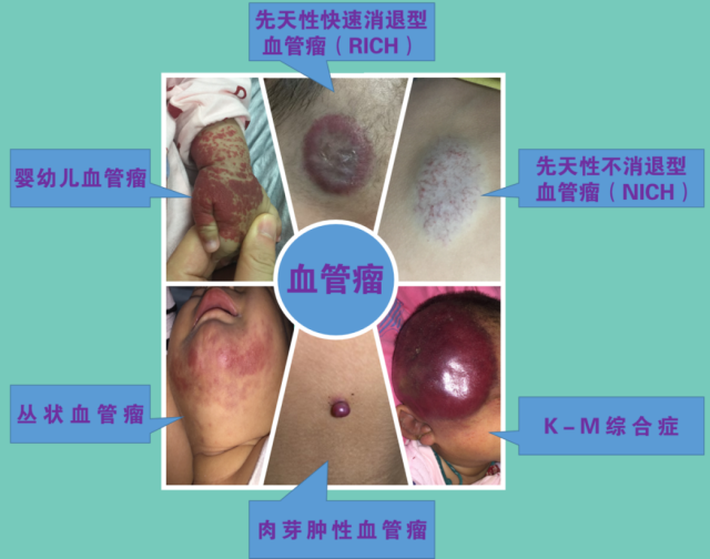 阿里健康首发：婴儿血管瘤外用原研药贝美净®马来酸噻吗洛尔凝胶