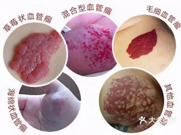 阿里健康首发：婴儿血管瘤外用原研药贝美净®马来酸噻吗洛尔凝胶