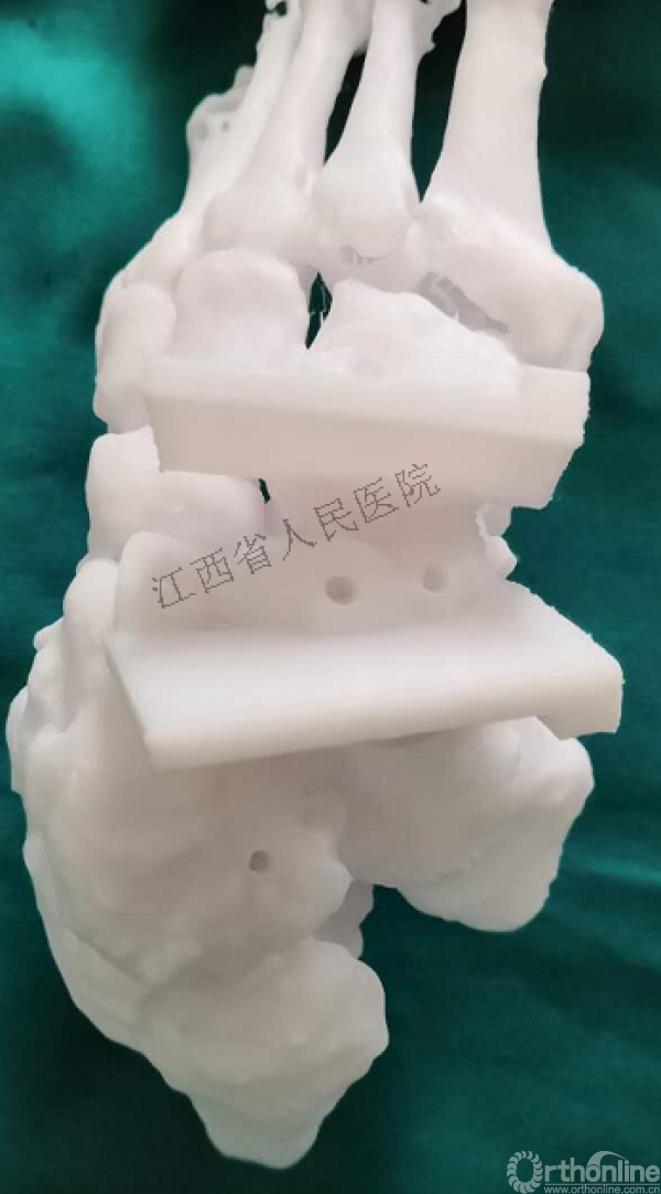 春立医疗获得发明专利授权：“一种仿生型假体截骨定位导板”